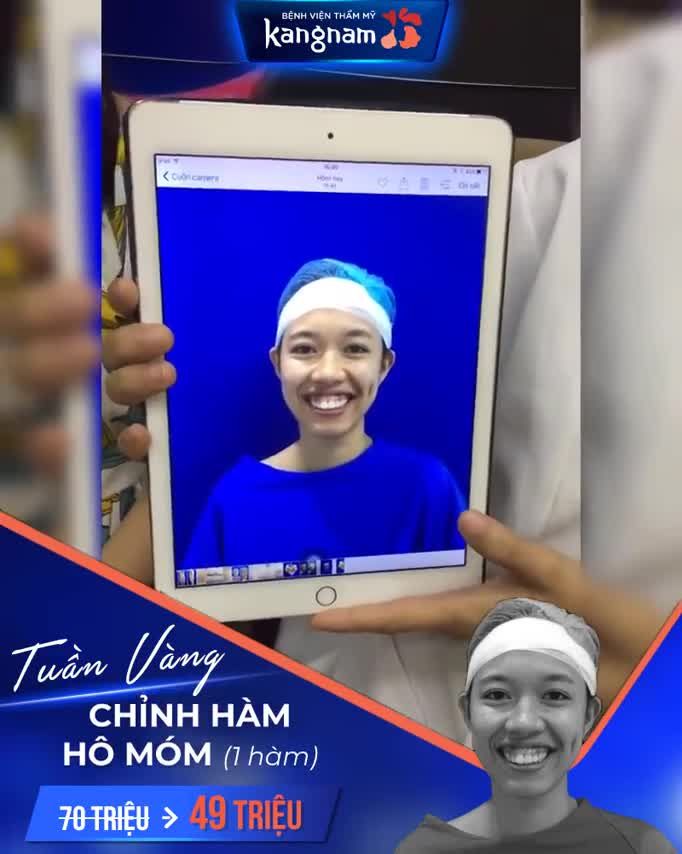 "LỘT XÁC" 360 ĐỘ sau CHỈNH HÀM HÔ 2 HÀM