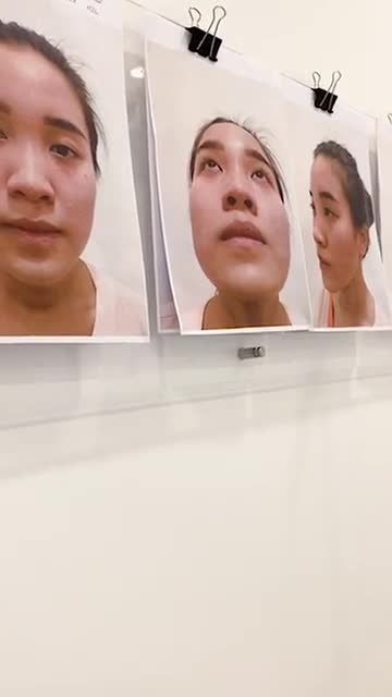 Ca nâng mũi cấu trúc cho khách hàng mũi ngắn hếch, lệch vách ngăn