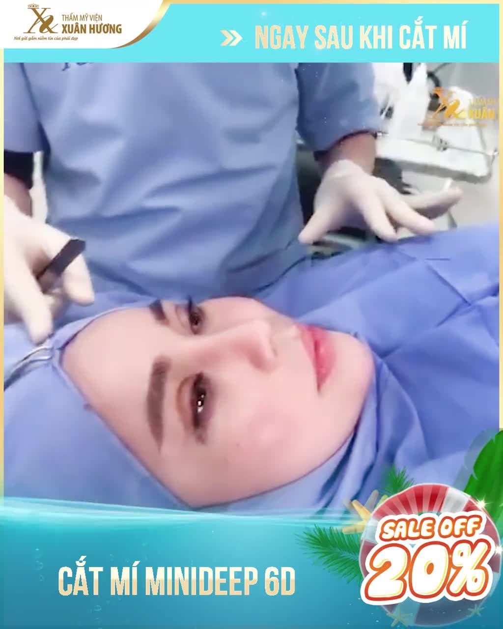 CẬN CẢNH CẮT MÍ MINIDEEP 6D TRÊN + DƯỚI NGAY KHI VỪA THỰC HIỆN XONG