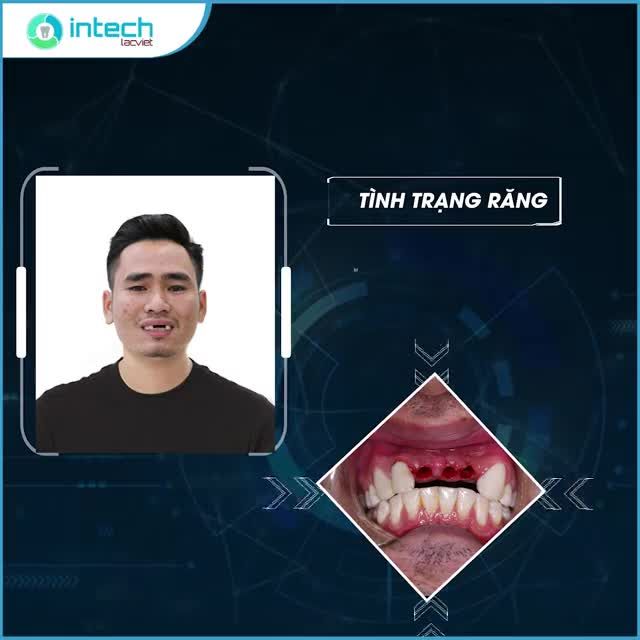 NỤ CƯỜI TỰ TIN - PHỤC HÌNH RĂNG CỬA VỚI IMPLANT