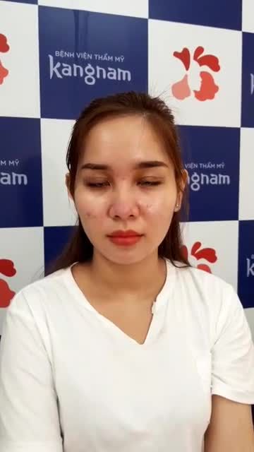 Thay đổi hoàn toàn diện mạo chỉ sau khi cắt mí 1 tháng