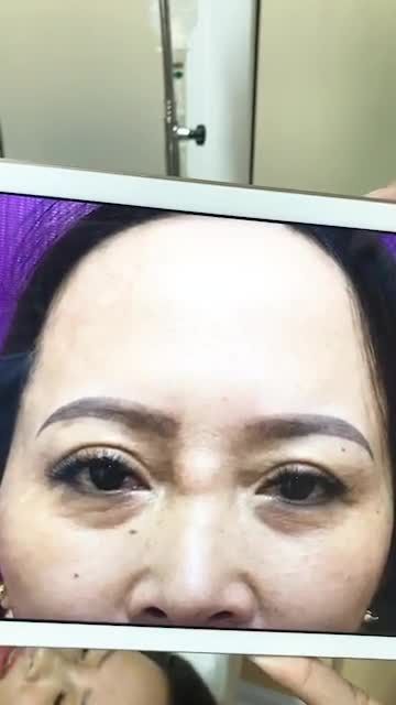 Khách hàng đã từng tiêm filler ở spa và gặp phải tình trạng vón cục ở sống mũi.