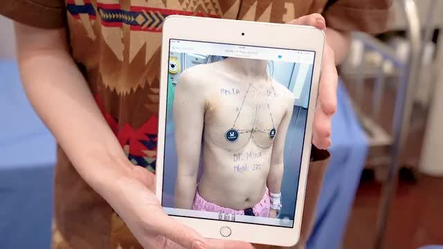 KH cắt chỉ VÒNG 1 sau 10 ngày