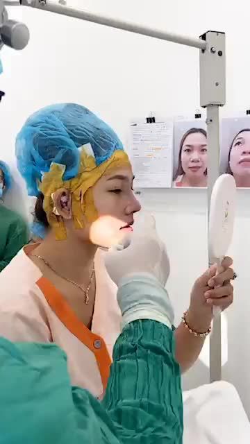 khách hàng sóng mũi thấp, mô đầu mũi to, cánh mũi to bè. Khách hàng đã sử dụng phương pháp cấu trúc sụn tai và sóng surgiform.