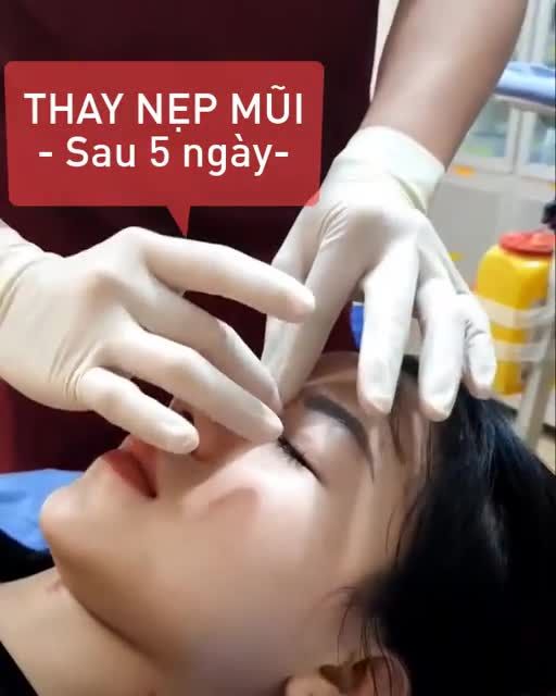 CẬN CẢNH 6 BƯỚC NẸP MŨI "CHUẨN" - Quyết định dáng mũi "cực phẩm" 40 năm