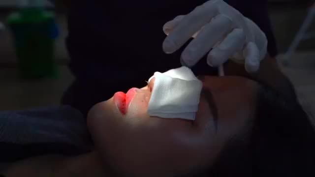 Bạn đang tò mò form mũi sau 10 ngày như thế nào!