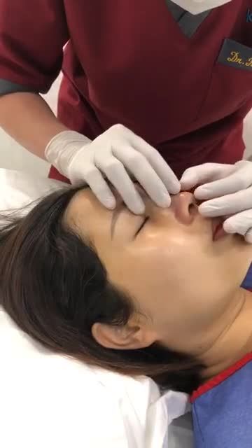 Đây là Quy trình quyết định MŨI CÓ ĐẸP ỔN ĐỊNH về sau!