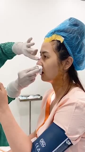 Khách hàng sóng mũi thấp, cánh mũi bè, da mỏng. Khách hàng đã sử dụng phương pháp cấu trúc sụn tai + bọc fascia.