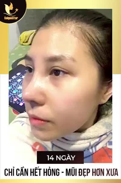 BÁC HOẠT ƠI! EM... CHỈ CẦN HẾT HỎNG - MŨI ĐẸP HƠN XƯA