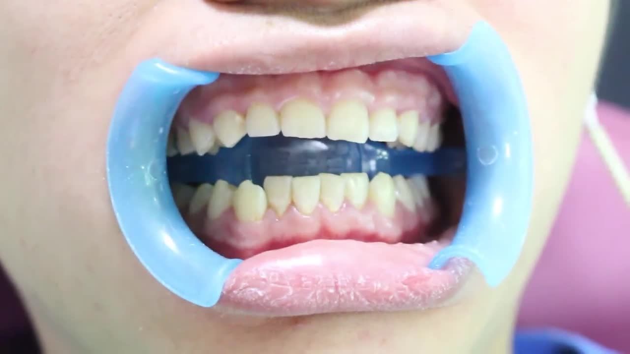 CÁC CÁCH GIẢM ĐAU KHI NIỀNG RĂNG