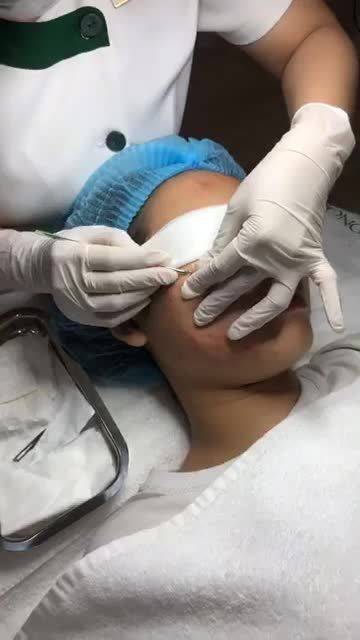MỤN - MỤN - MỤN