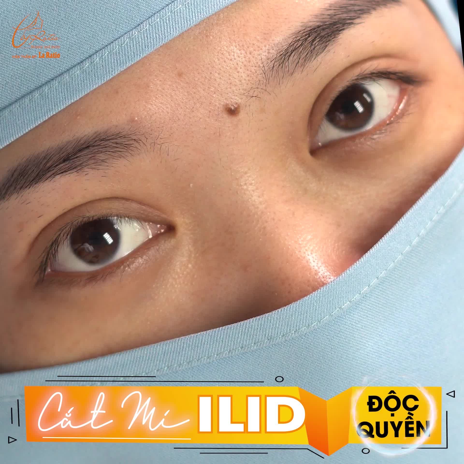 CẮT MÍ ILID – MẮT ĐẸP “HÚT HỒN” NGAY SAU 4 NGÀY