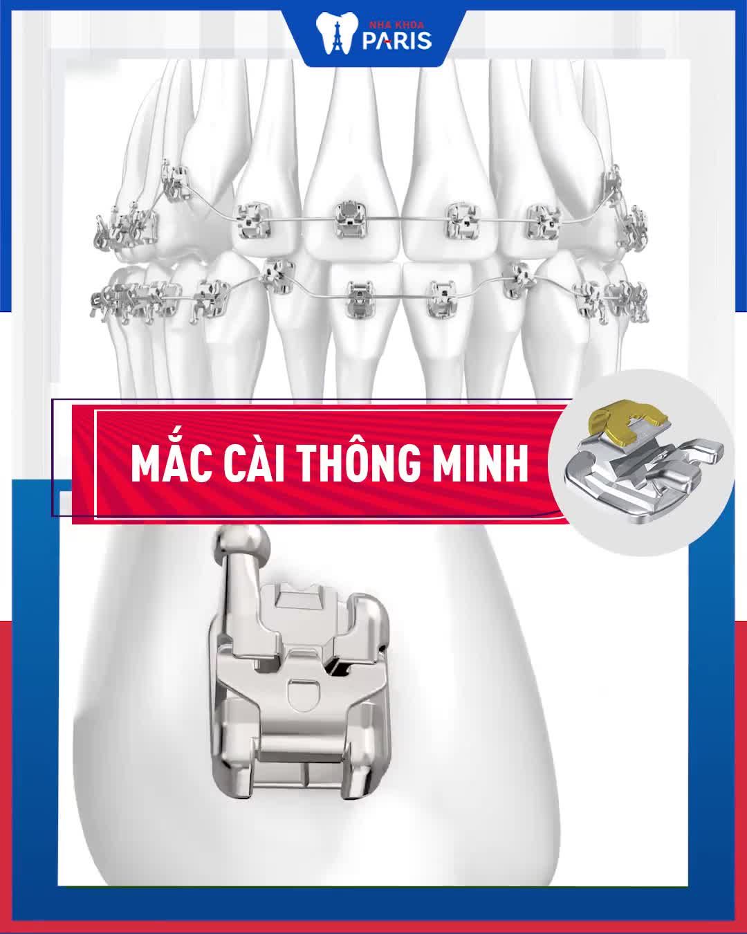 RĂNG THƯA ‼ RĂNG HÔ ‼ RĂNG MÓM ‼ KHẤP KHỂNH