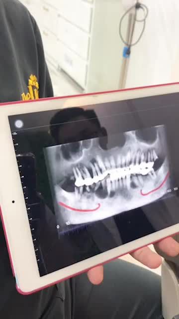 CẢM NHẬN KHÁCH HÀNG CẤY 7 TRỤ IMPLANT - NHỔ RĂNG KHÔN LỢI TRÙM GÂY NHỨC NHỐI TRONG THỜI GIAN SIÊU NHANH BẰNG CÔNG NGHỆ PIEZOTOME