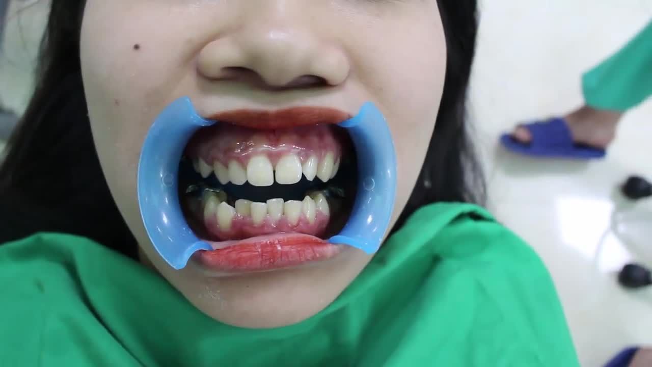 MỘT SỐ CHÚ Ý KHI NIỀNG RĂNG ‼️