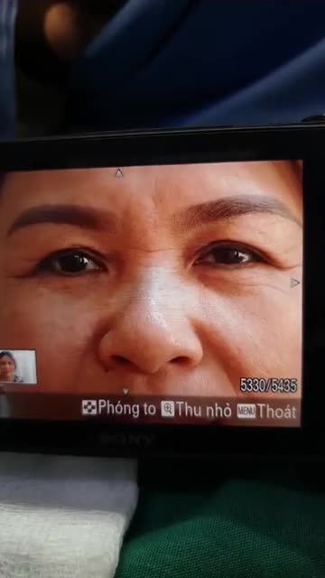 Nâng mũi bán cấu trúc đa lớp và treo cung chân mày 2 lớp Kỹ Thuật độc quyền của bs Kỳ Y Dược