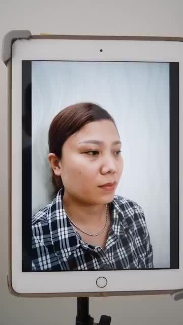 TÁI KHÁM NÂNG MŨI CẤU TRÚC SAU 2 THÁNG