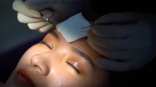 Cận cảnh quá trình cắt chỉ mí Mani Open Deep 5D sau 7 ngày