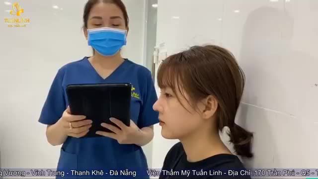 Case nâng mũi siêu cấu trúc sụn Surgiform tái khám sau 10 ngày tại VTM Tuấn Linh