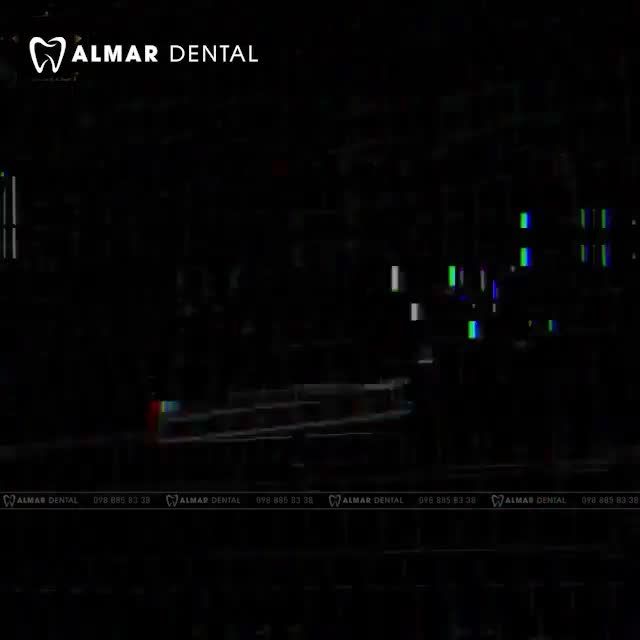 CHỈ 35 PHÚT KHÔNG ĐAU  TẠM BIỆT NỤ CƯỜI HỞ LỢI BẰNG PHƯƠNG PHÁP ĐIỀU TRỊ CƯỜI HỞ LỢI ĐỘC QUYỀN TẠI ALMAR DENTAL