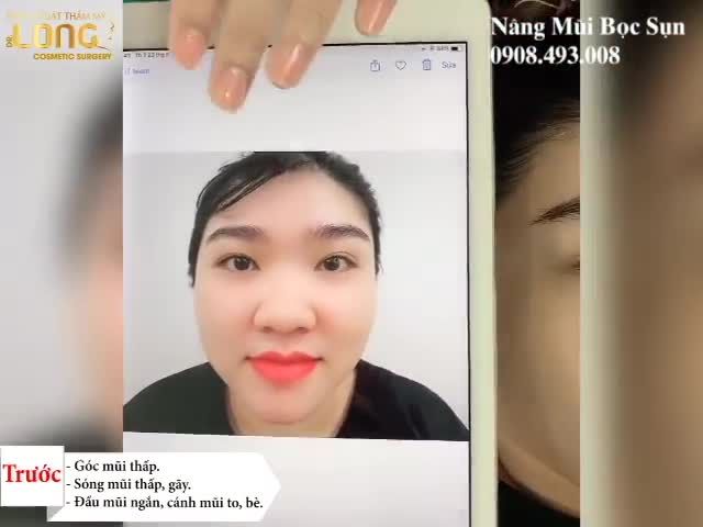 Chỉ với 30 phút cho 1 dáng mũi đẹp - Tại Sao Không ?