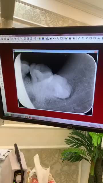 HIẾM CÓ KHÓ TÌM - RĂNG KHÔN KỲ LẠ