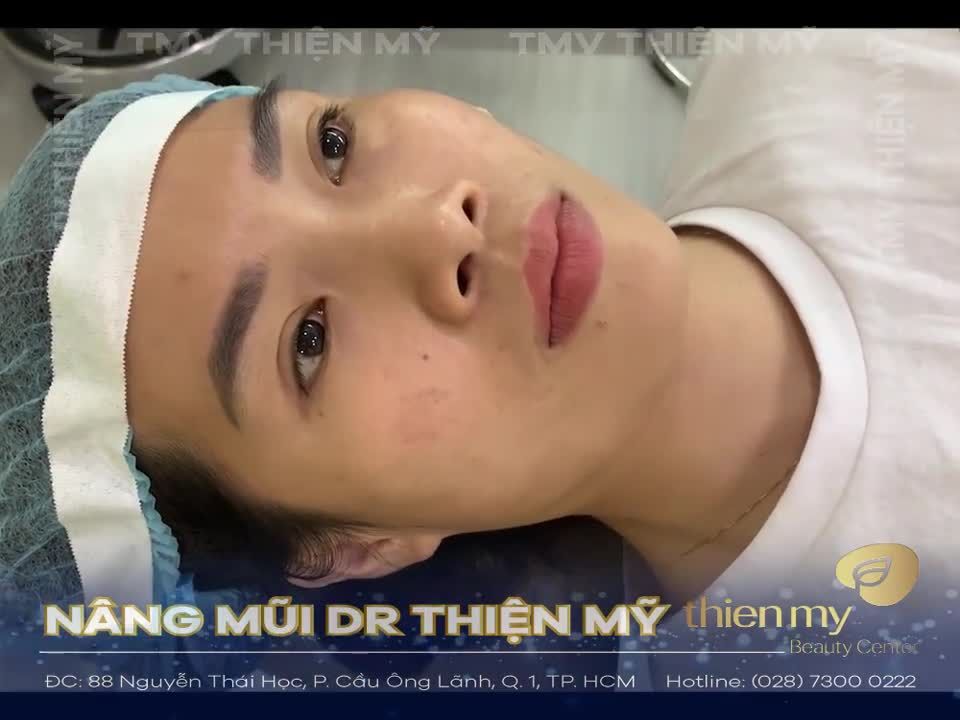 HÔ BIẾN MŨI TẸT - CHUẨN ĐẸP VIỆT NAM