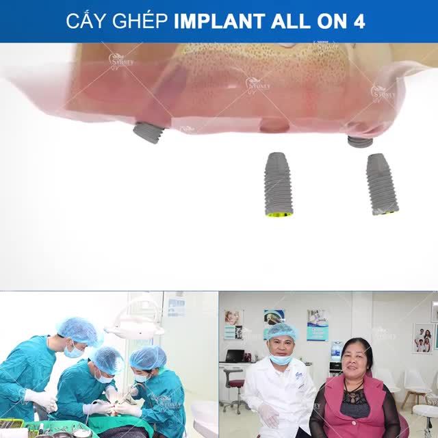 IMPLANT ALL ON 4 VÀ IMPLANT ALL ON 6 KHÁC NHAU NHƯ NÀO