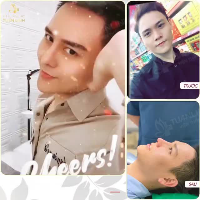 Nâng mũi Siêu cấu trúc Surgiform DÁNG MŨI CAO CẤP - CHUẨN TỈ LỆ VÀNG