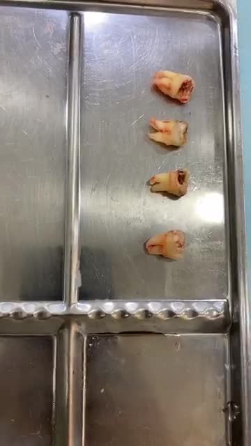 Nhổ 4 răng chân cong chỉ cần 10 phút