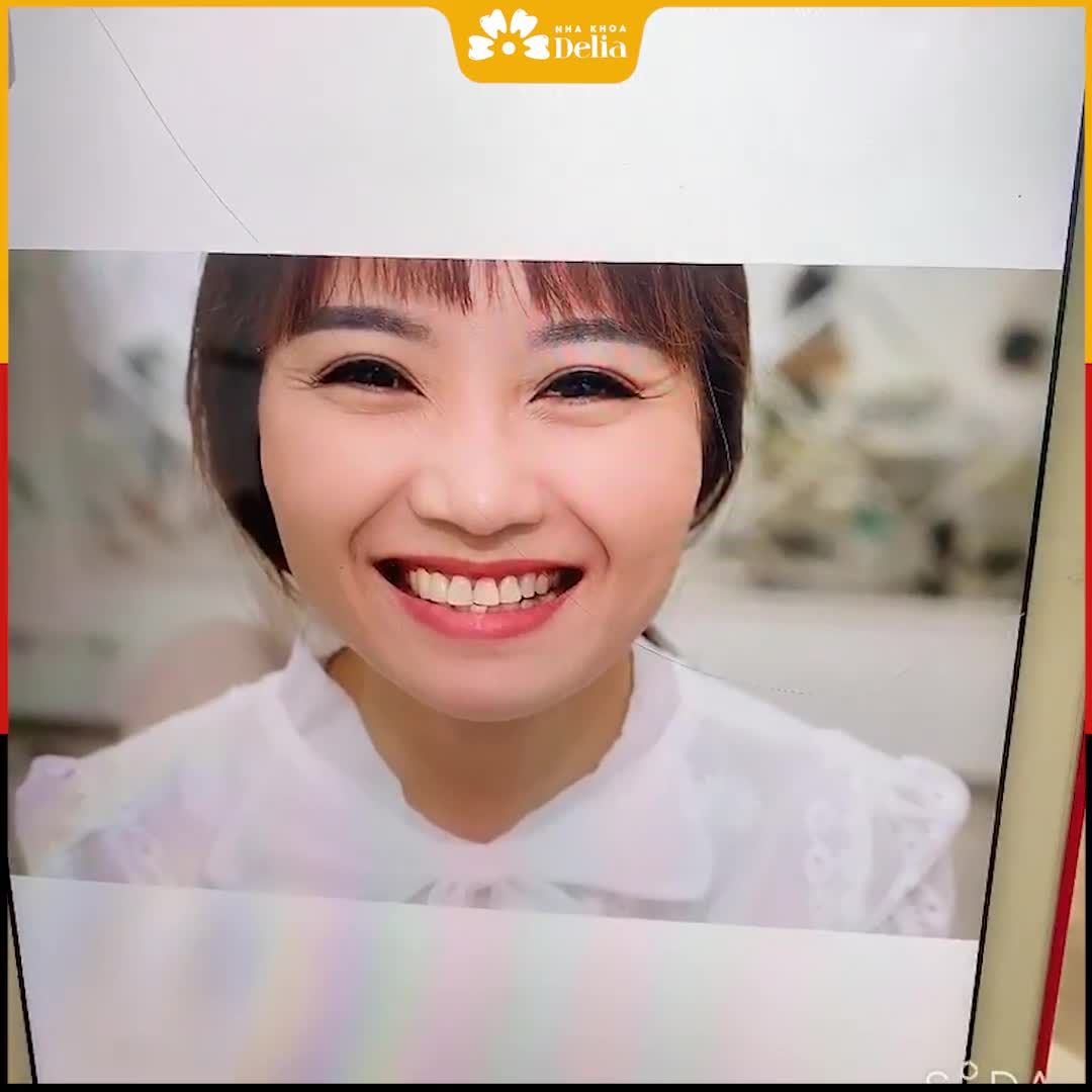 Chia sẻ của khách hàng sau 2 NĂM THẨM MỸ RĂNG SỨ