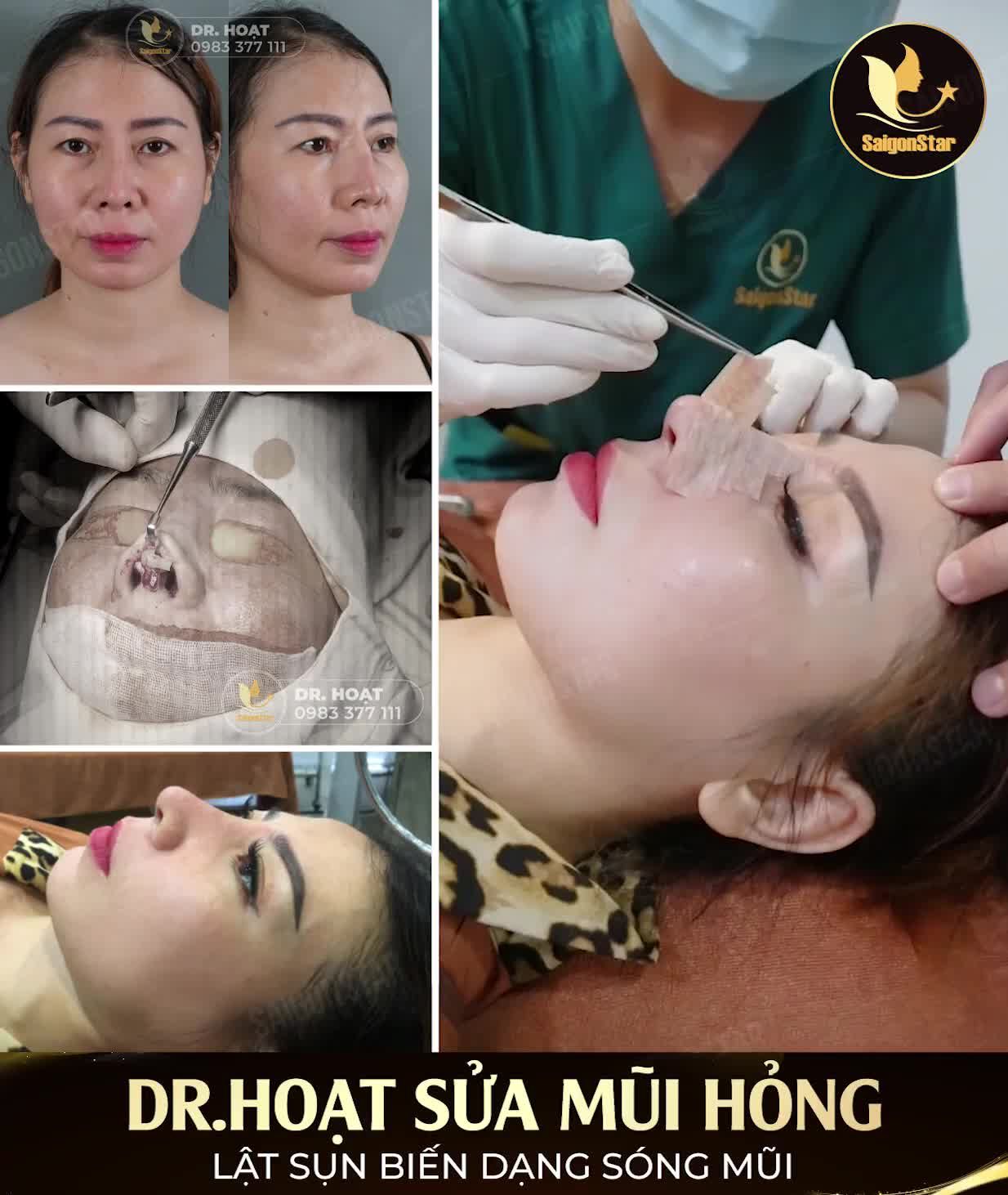 DR.HOẠT SỬA MŨI HỎNG LẬT SỤN BIẾN DẠNG SÓNG MŨI