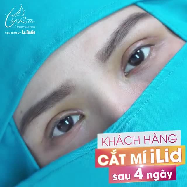 KHÁCH HÀNG CẮT CHỈ SAU 4 NGÀY THỰC HIỆN CẮT MÍ ILID