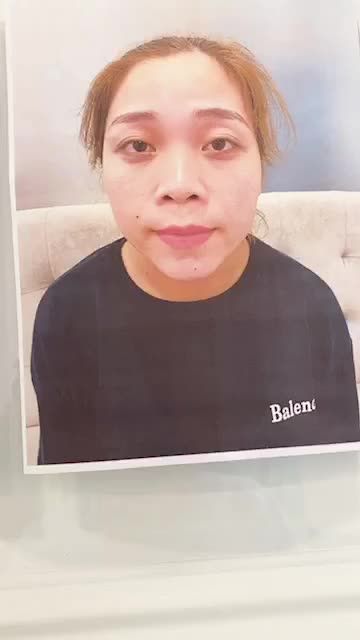 Khách hàng sóng mũi thấp, đầu mũi ngắn , da mui mỏng, sử dụng phuong pháp nâng mũi cấu trúc sụn tai kết hợp bọc cân cơ thái dương fascia