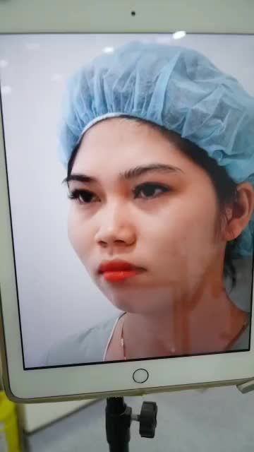 CHIẾC MŨI THẤP, CÁNH MŨI TO BÈ ĐÃ ĐƯỢC KHẮC PHỤC HOÀN TOÀN DR. HOẠT - BẬC THẦY NÂNG MŨI