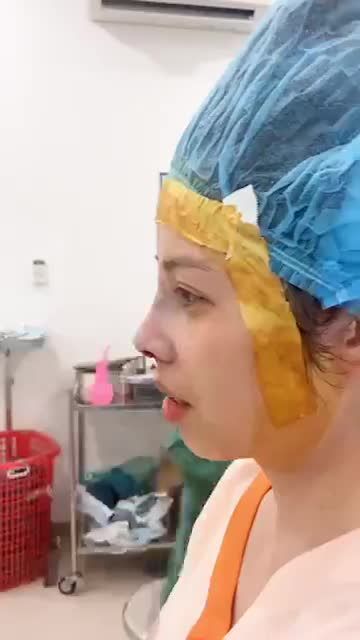 Khách hàng mũi ngắn hếch, trước đây từng té xe đứt tuyến lệ, nền xương không đều.