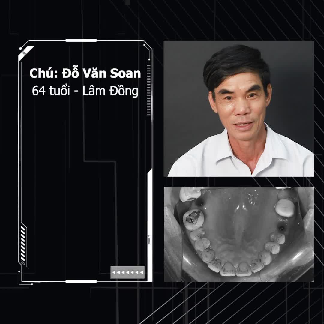 VƯỢT ĐƯỜNG XA RA HÀ NỘI TRỒNG RĂNG IMPLANT tại NHA KHOA THÙY ANH