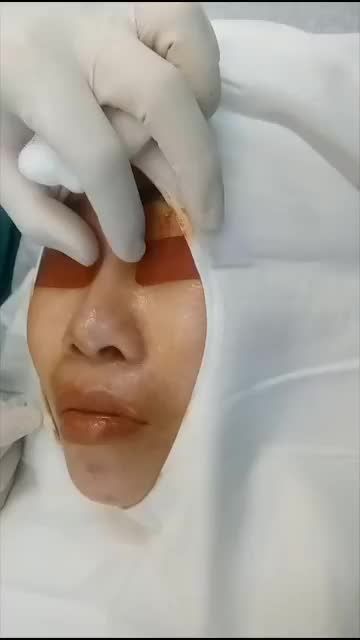 BÁC SĨ HOẠT VỪA THỰC HIỆN XONG MỘT CA NÂNG MŨI CẤU TRÚC SỬA LẠI