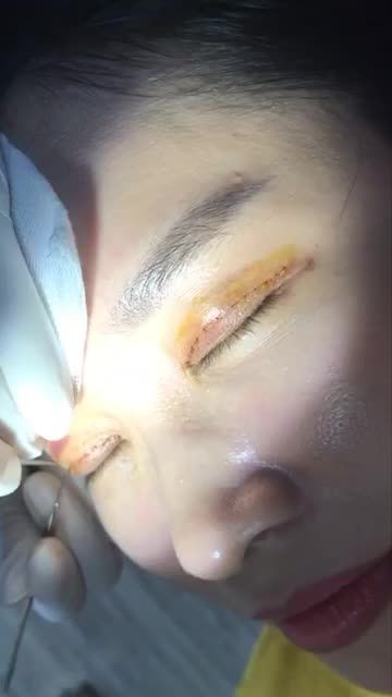 Cắt chỉ mí mắt sau 7 ngày phẫu thuật. Giải pháp số 1 loại bỏ da thừa, nếp nhăn và bọng mỡ mí dưới chỉ sau 1 lần.