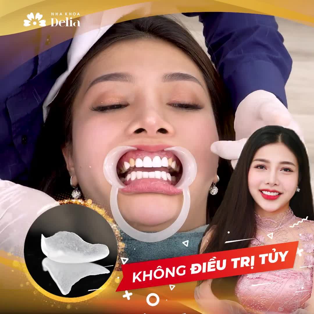 Dán sứ Veneer không mài nhỏ - Bảo tồn răng răng gốc!