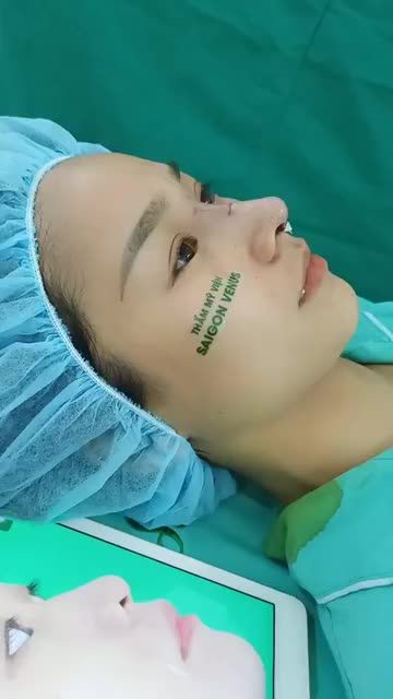 KẾT QUẢ NÂNG MŨI PHƯƠNG PHÁP CẤU TRÚC FASCIAL