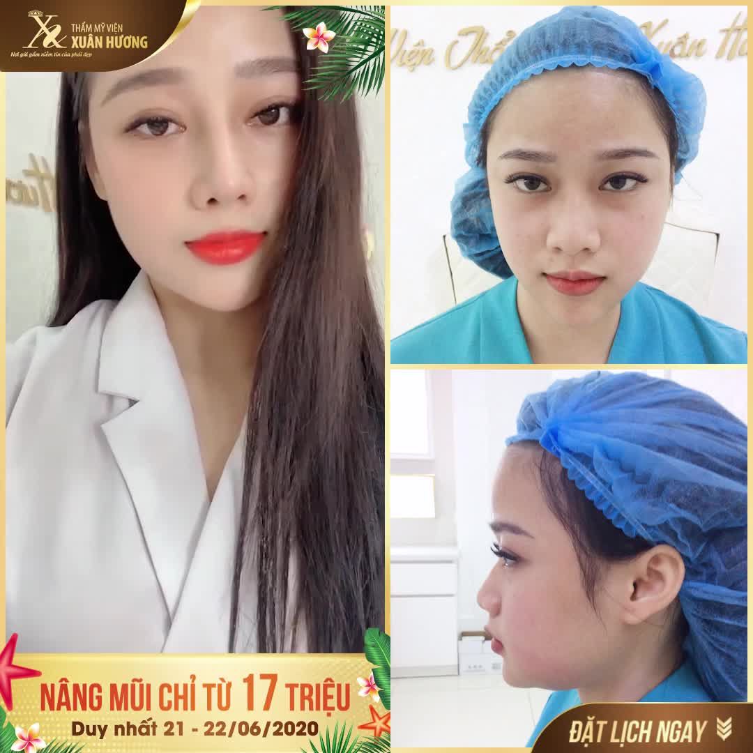 NÂNG MŨI CHỈ TỪ 17 TRIỆU - TIN ĐƯỢC KHÔNG?