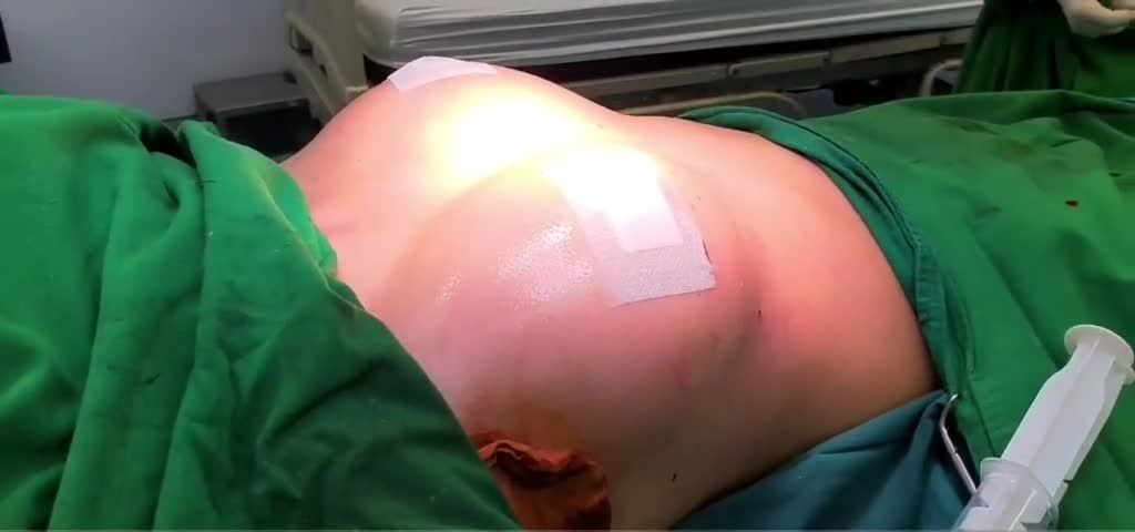 Nâng ngực nội soi chân không kỹ thuật độc quyền của Bác sĩ Kỳ Y Dược