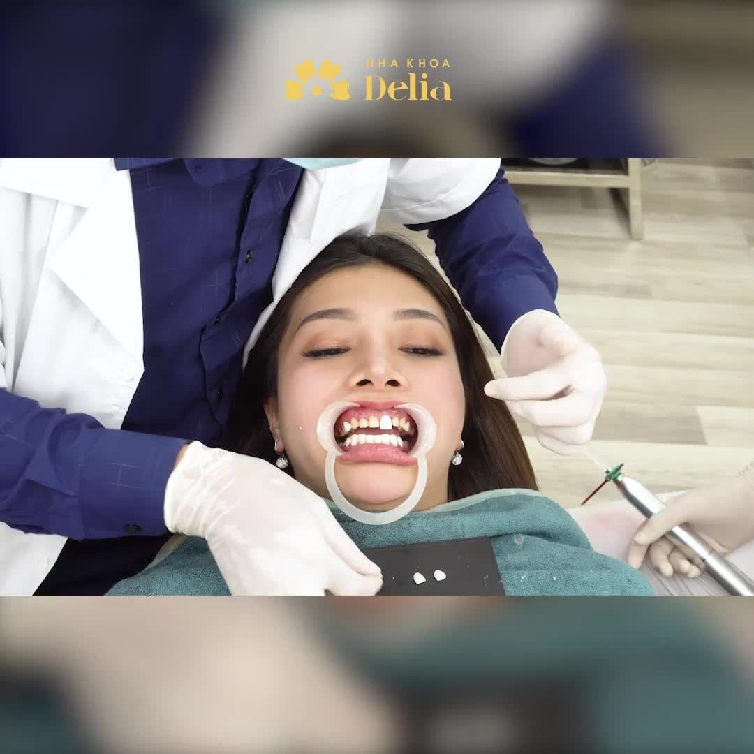 DÁN SỨ VENEER TẠI DELIA CÓ GÌ HOT Khám phá ngay
