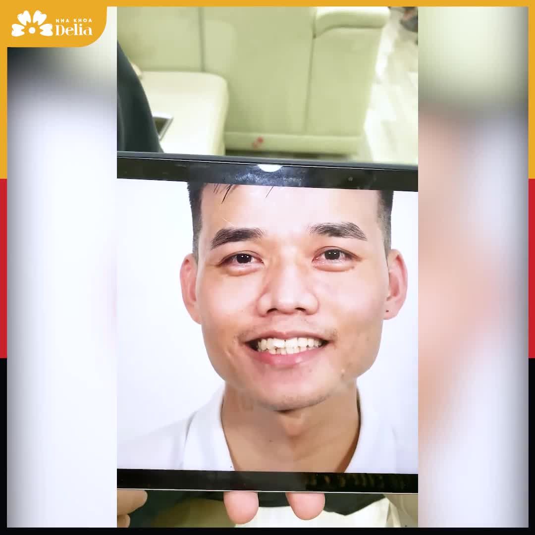 "Phụ nữ làm răng là chuyện bình thường, bây giờ nam giới làm răng mới là xu hướng" - Chia sẻ của khách hàng Trần Thiệu