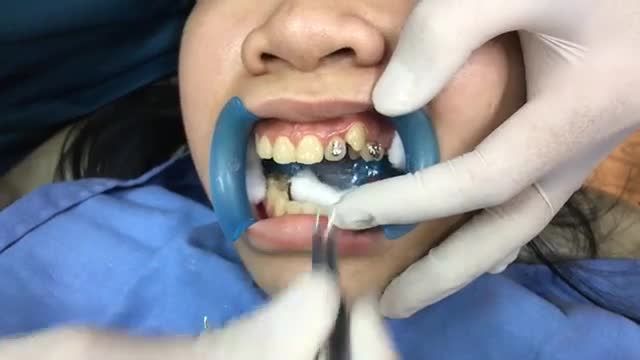 Gắn mắc cài chỉnh nha cho bạn Hải Dương điều trị răng lệch lạc, khớp cắn sâu.