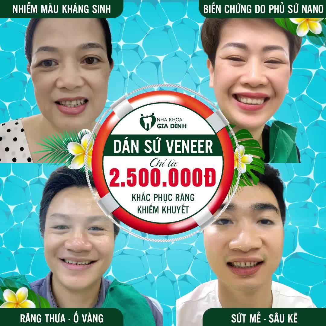 DÁN SỨ VENEER: PHỤC HÌNH KHIẾM KHUYẾT RĂNG XẤU, SỞ HỮU NỤ CƯỜI HOÀN MỸ