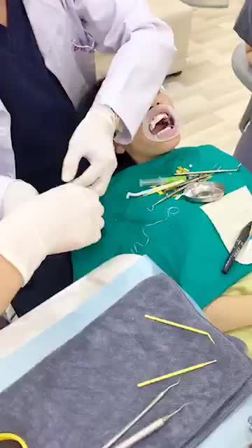 Cận cảnh ca dán sứ Veneer không mài nhỏ răng thật tại Delia