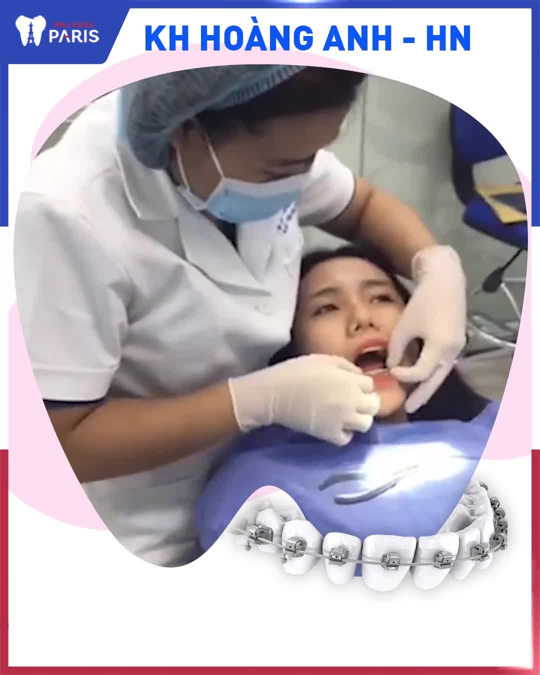 Răng khấp khểnh, cắn chéo, hàm hô - KH Hoàng Anh (Hà Nội)