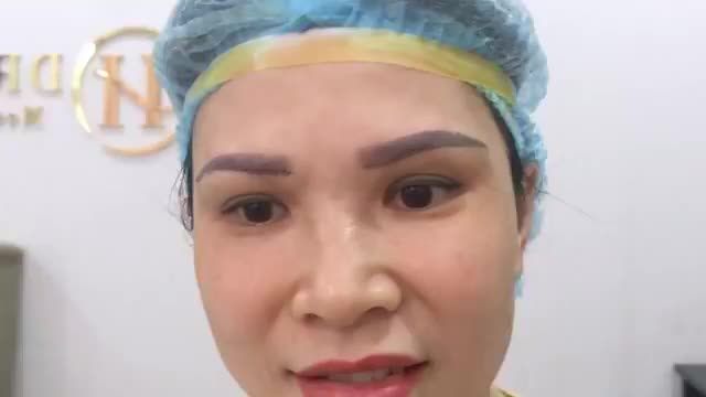 Tình trạng ban đầu: Da thừa nhiều che mí mắt.